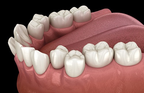 Illustration of crowded teeth