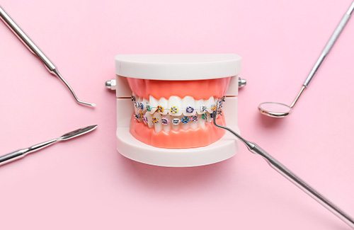 a model of teeth with braces