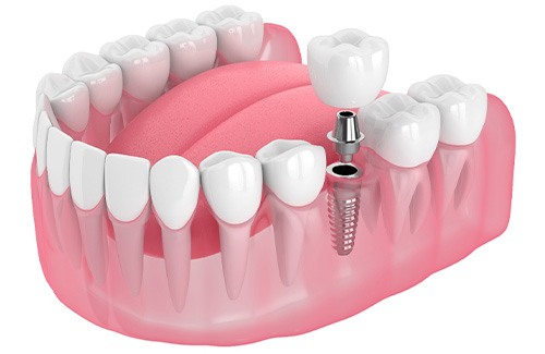 Illustration of a single dental implant