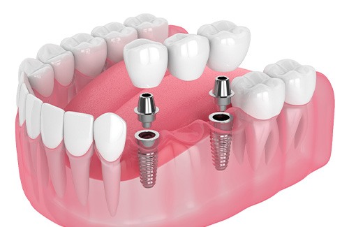 Illustration of an implant bridge