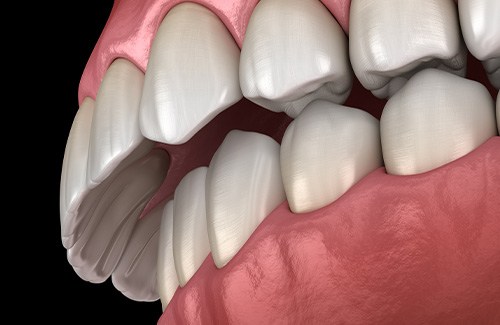 Illustration of overbite