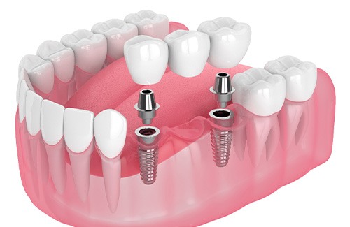 Illustration of an implant bridge