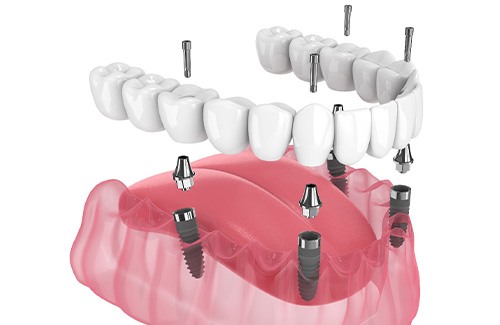 Illustration of an implant denture
