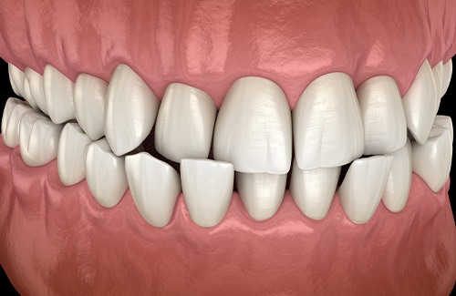 Illustration of crossbite