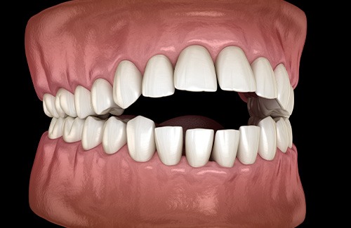 Illustration of open bite