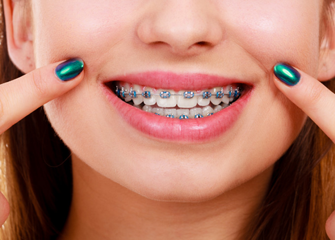 a patient with braces showing off her teeth