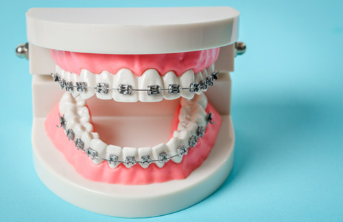 a tooth model with metal braces