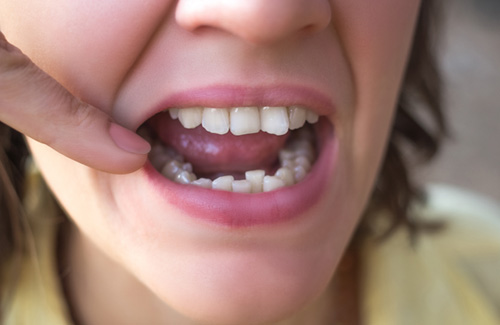 a close-up of a patient with crooked teeth