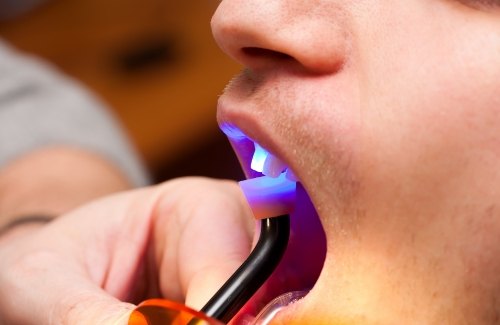 Close up of dental patient getting cosmetic bonding on a front upper tooth