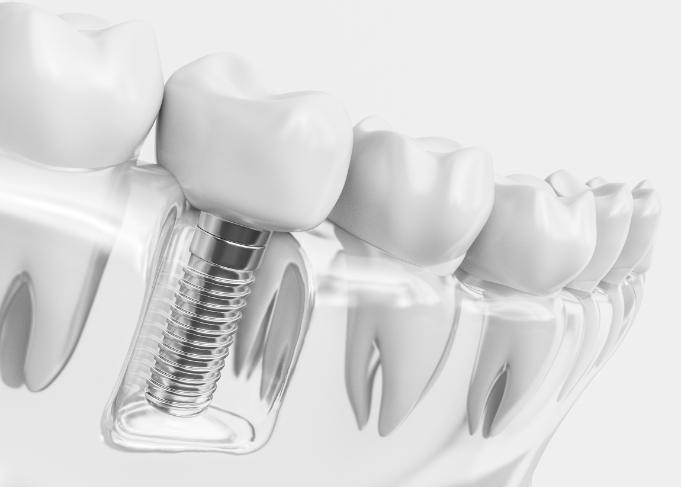 Model of the mouth with a dental implant in West Jordan replacing a tooth