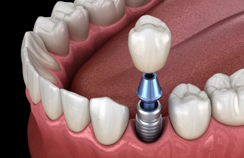 Illustrated dental implant with abutment and dental crown being placed