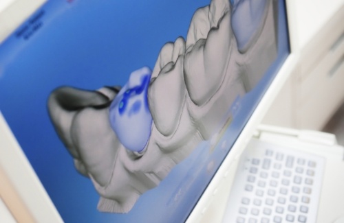 Computer screen showing digital model of a row of teeth