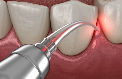 Illustrated dental laser treating gum disease