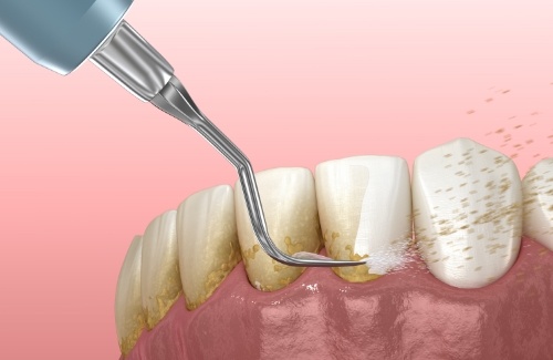 Illustrated dental instrument cleaning plaque from teeth