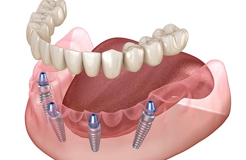 Illustration of an implant denture in West Jordan
