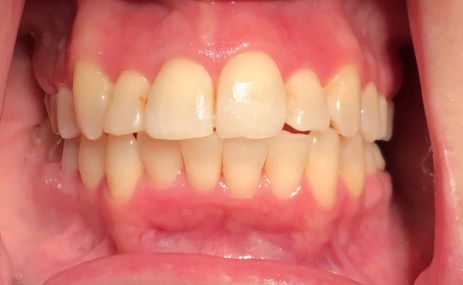 Smile with yellow teeth before dental treatment