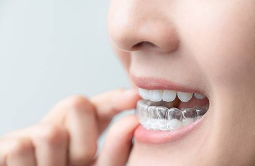 Patient putting on clear aligner