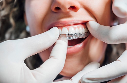Dentist putting clear aligner on patient