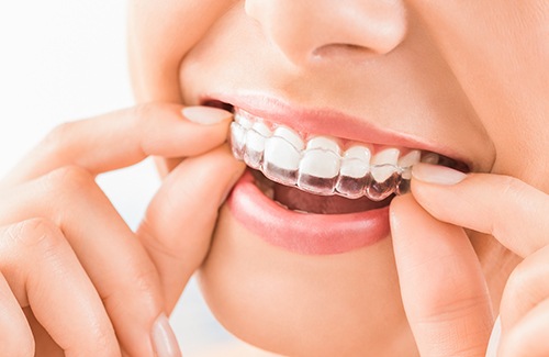 Close-up of person putting Invisalign on upper teeth
