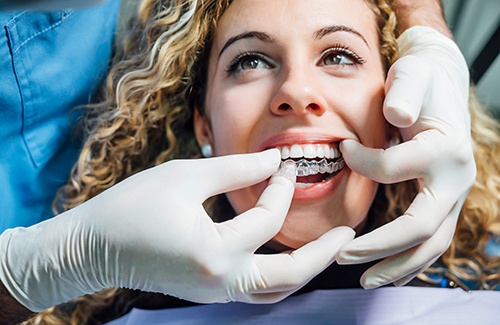 Placing Invisalign aligner on woman’s upper teeth