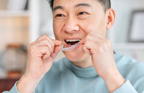 Older man putting in Invisalign aligner