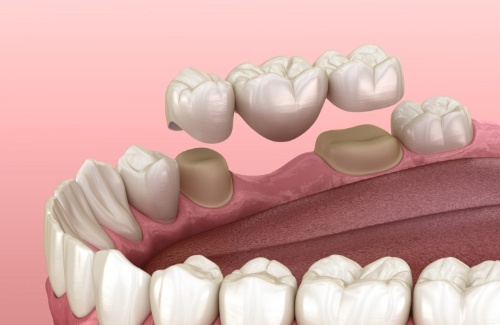 Illustrated dental bridge replacing a missing tooth