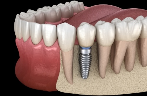 Illustrated dental implant with crown replacing a missing tooth