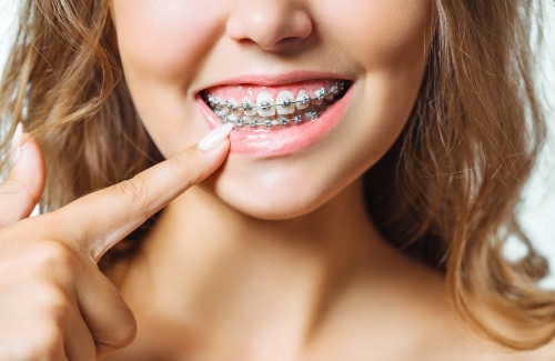 Young woman with traditional braces pointing to her smile