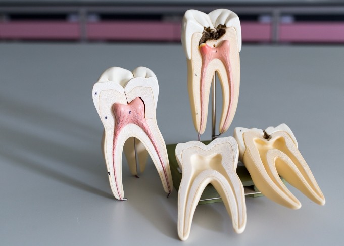 Models of decayed teeth that could use root canal treatment in West Jordan