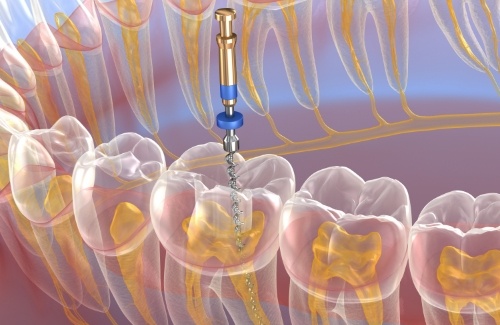 Illustrated dental instrument treating the inside of a tooth