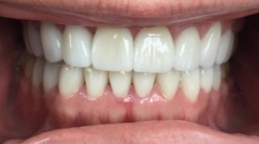 Smile with whiter and more evenly spaced teeth