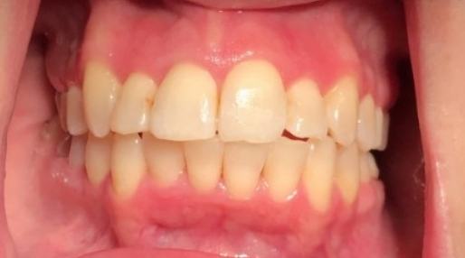 Close up of smile with yellowed teeth before treatment from West Jordan dentist
