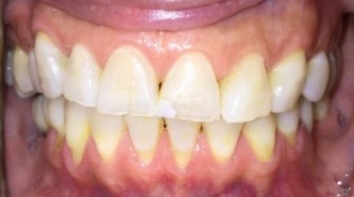 Smile with yellowed and slightly damaged teeth