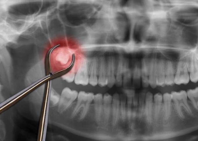Dental forceps in front of x ray of teeth with wisdom tooth highlighted red
